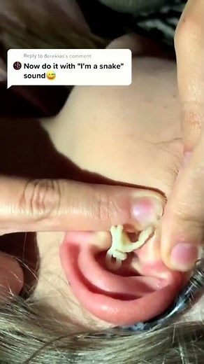 Cystic acne and blackheads removal - Newest pimple pops for 2022