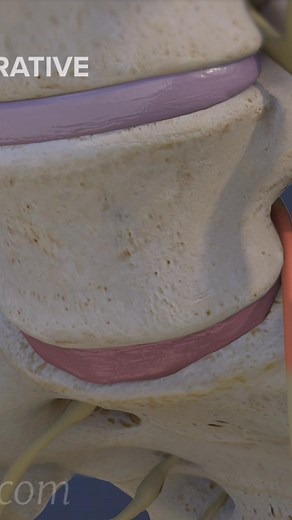 13K views · 81 reactions | Need answers about L5-S1 degenerative disc disease? 樂 This video explains the causes, symptoms, and treatment options for lower back pain caused by degeneration at the L5-S1 spinal level. Learn about common issues like sciatica, disc bulging, and nerve compression, plus ways to find pain relief and improve mobility. 領 | Spine-health | Facebook