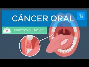 Câncer oral: Epidemiologia, fatores de risco, prevenção, sintomas, diagnóstico e tratamento | Kenhub