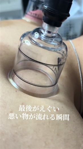 #吸玉#肩こり#腰痛