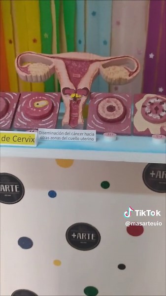 Maqueta del Cáncer de Cérvix para Educación