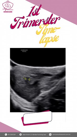 Essential First Trimester Ultrasound for Pregnancy Health