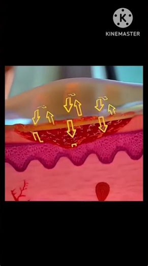 What to do if your hand gets burned