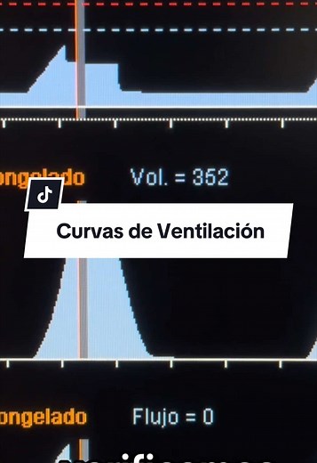 Curvas de ventilación mecánica: presión, volumen y flujo en 1 minuto
