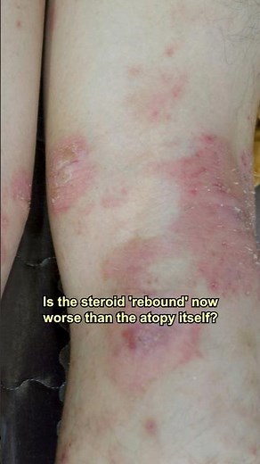 Steroid-Free Atopy Treatment that WORKS