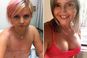 Breast cancer sufferer, 44, shares confronting photo of her double mastectomy scars and says ‘all women need to see this’