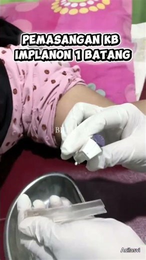 Installation of KB Implanon NXT 1 rod 🤗 #kbimplan #kbimplant