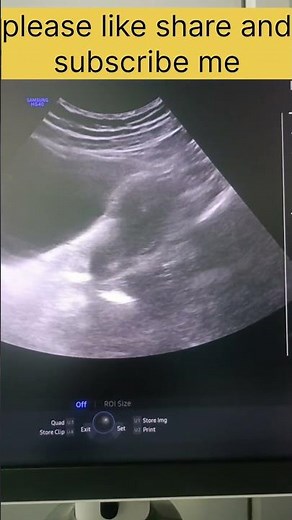 Thickness of endometrial #education #ultrasound
