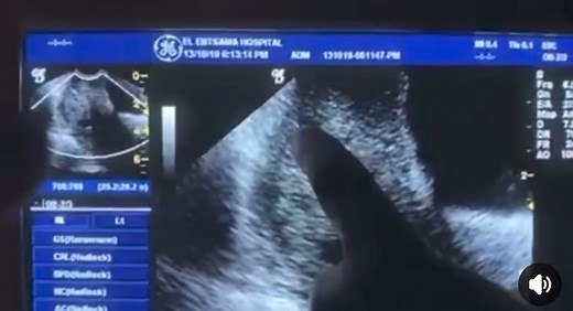 4.6K views · 58 reactions | Uterine arteriovenous malformations...