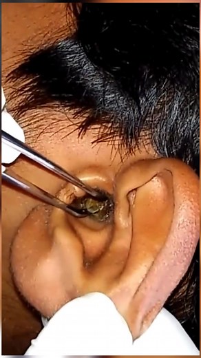 Effective Ear Wax Removal Techniques