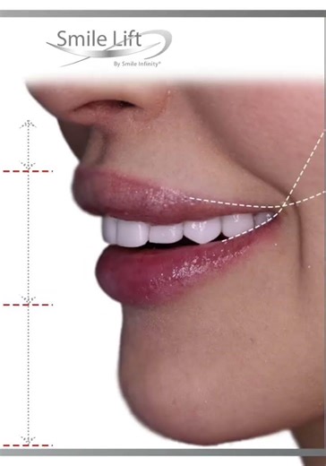 Smile Lift® Facial Rejuvenation Through Dentistry — Dr Habib Zarifeh, Lebanon