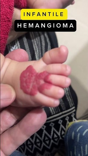 Infantile Hemangioma #hemangioma #infants #treatment