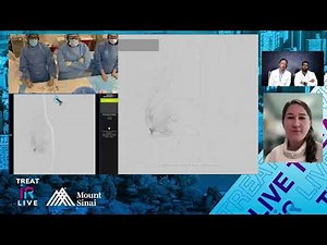 Transfemoral Genicular Artery Embolization (GAE) for Knee Osteoarthritis