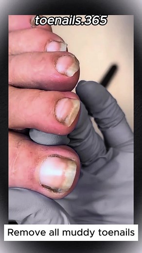 Effective and Safe Ingrown Toenail Removal Techniques