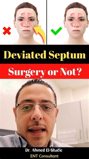 Deviated Septum Surgery: When Is It Really Necessary?