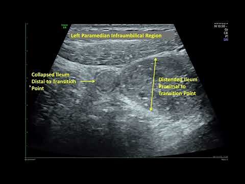 Bowel Adhesion Causing Subacute Small Bowel Obstruction-Ultrasound Demonstration of Transition Point