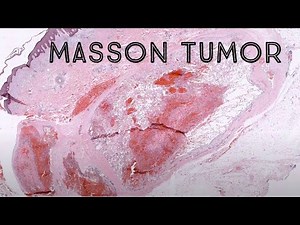 Masson "Tumor” (Intravascular papillary endothelial hyperplasia IPEH) pattern of organizing thrombus