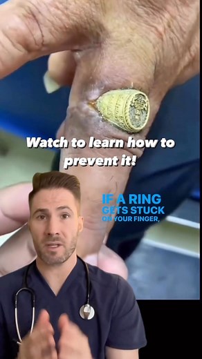 Dr. Joe, M.D. | The string method is a common technique used to remove a ring stuck on a finger. It involves taking a thin, non-elastic string or thread... | Instagram