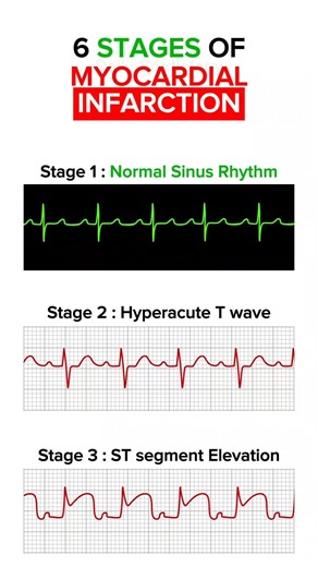 6 stages of ECG changes in Myocardial Infarction #ecg #stemi #myocardialinfarction #cardiology