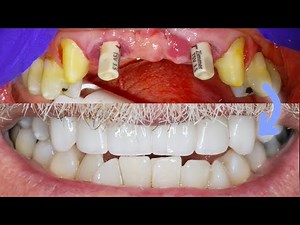 IMMEDIATE IMPLANT BRIDGE PROCEDURE On Front Teeth! Extraction, Bone Graft & Crown Placement Surgery