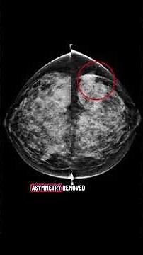 Explaining why focal asymmetry may not need to be removed surgically #mammogram #womenshealth