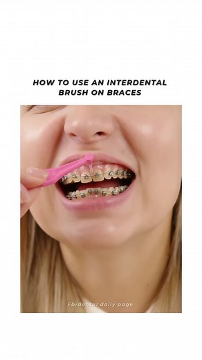 How to use interdental brushes:- 🦷 Aim to clean your teeth with interdental brushes once a day before brushing. 🦷 Use a brush appropriate for the size of the space between your teeth – you may need to use more than one size. 🦷 Insert the brush gently between your teeth, and try a smaller brush size if it feels too tight – don't try to force the brush into the space. 🦷 Work round the whole of your mouth so you don't miss any of the spaces. (Source: www.nhs.uk) #braces #braceslife #braceson #b