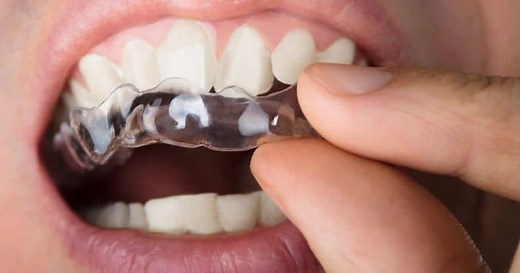 DR SMILE Erfahrungen: Wie gut sind die Aligner wirklich?