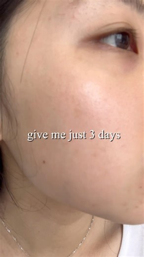 Give me just 3 days with Madeca Powder Tea Tree AC💚