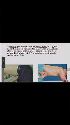 Puddle sign- Ascites | Medicine | like, share and Subscribe | #mbbs #neet #shorts #trending