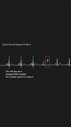 Second Degree Heart Blocks - Type I vs Type II