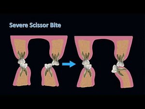 Correcting severe scissor bite in an adult