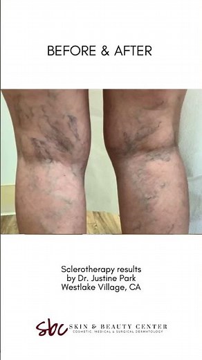 Sclerotherapy Before & After (2 treatments)