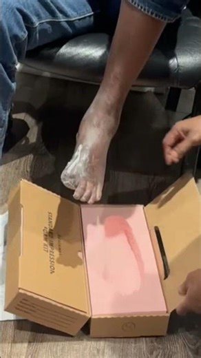 Molding For Diabetic Foot Orthoses