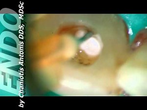 Orthograde Retreatment of Immature Root • Video • MEDtube.net