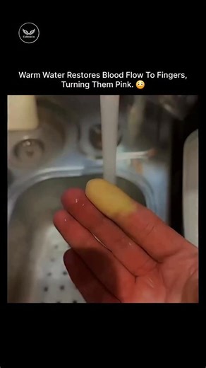 Culdwar.io on Instagram: "The video illustrates a straightforward physiological response: fingers displaying yellowish pallor, indicative of reduced peripheral blood flow, are submerged in warm water running from a faucet, prompting a rapid vasodilation that restores circulation and shifts the skin tone to a healthy pink within seconds. This phenomenon underscores a prevalent challenge in labor-intensive sectors, such as agriculture, construction, or food processing in regions like rural India, 