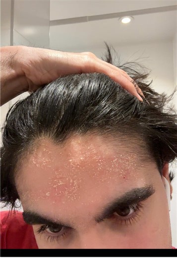 Managing Seborrheic Dermatitis with SebRx