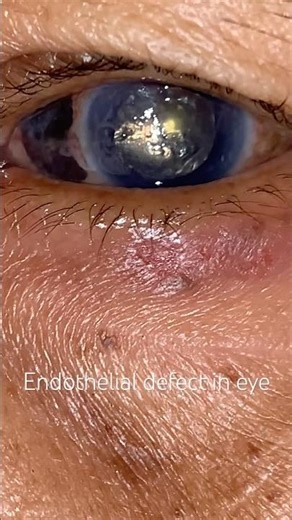 Endothelial defects in eye #anatomy #eyes #eyeanatomy #viral #human #cornea #eye7