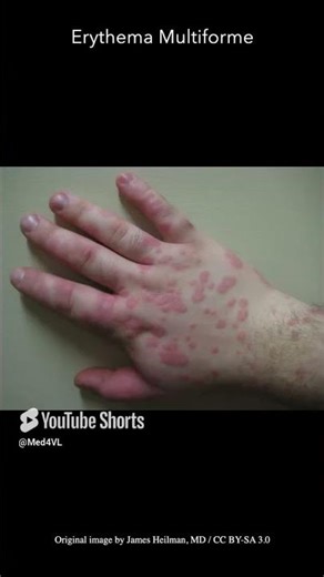 Erythema Multiforme