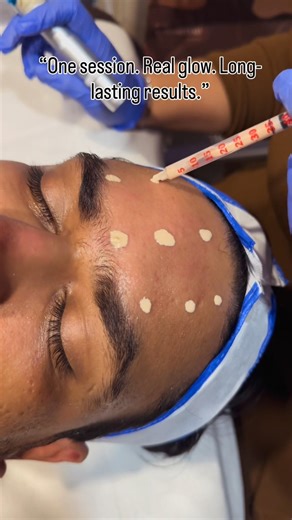 “This is not makeup… this is BB Glow skin treatment.” #bbglowtreatment #pmu #skinrejuvenation