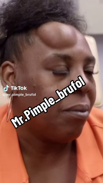 #mrpimplebrufol #mrpimple_brufol #brufol #face #facepimples #facepimplesolution #pimplesfacetats #pimplefacecream #pimplepopperaddict #facepimplestreatment #facepimlereomove #pimplepopper #pimplepatch #zits #acne #satysfing #satysfaction #puspimple #foryou #fypシ゚viral