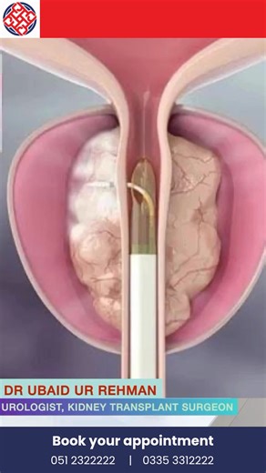 Rezum (Water Vapor) Therapy for Enlarged Prostate – Explained by Dr. Ubaid Ur Rahman, Urologist Discover how Rezum Therapy uses the power of water vapor to treat enlarged prostate (BPH) without surgery. In this video, Dr. Ubaid Ur Rahman, a leading urologist, explains how the minimally invasive procedure works, its benefits, and who it’s best for. #RezumTherapy #WaterVaporTreatment #BPH #EnlargedProstate #UrologyCare #DrUbaidUrRahman #MinimallyInvasive #MenHealth #UrologistPakistan #ProstateHeal