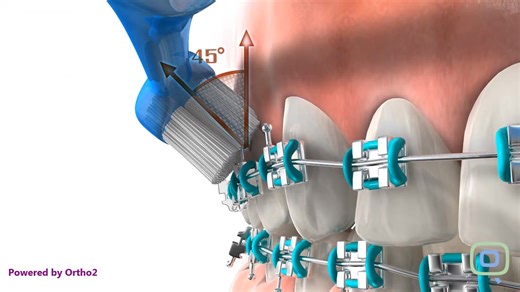 Taking care of your braces is crucial to ensure a smooth and effective orthodontic treatment. Here are some key points to keep in mind: - Good Oral Hygiene: Brush and floss regularly to prevent decay and gum disease around the braces. Use a fluoride toothpaste and a soft-bristled toothbrush to clean your teeth and braces. - Diet: Avoid eating hard, sticky, or crunchy foods that can damage or break your brackets. - Bracket Care: If a bracket comes loose, get it replaced quickly to avoid delays in