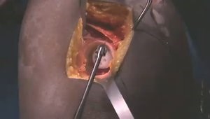 Custom Total Hip Replacement - Posterior Approach