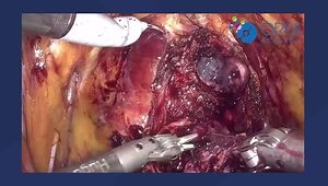 Robot-Assisted Radical Prostatectomy: Posterolateral Bladder Neck, Collar Technique and Hydrodissection Tips