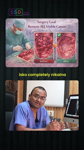 HIPEC With Cytoreductive Surgery Explained In 30 Seconds! | Dr Praveen Kammar, Mumbai