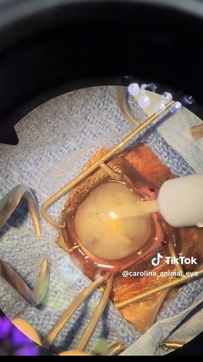 Cecelia's Unilateral Cataract Surgery Experience