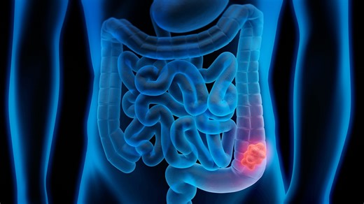 Study Reveals Promising Results in Fight Against Colon Cancer