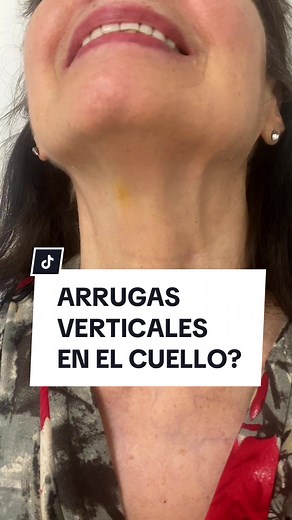 Técnica avanzada de toxina botulínica para rejuvenecer el cuello