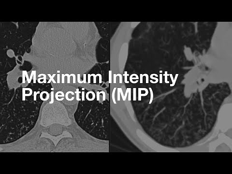 What's the deal with MIPs?