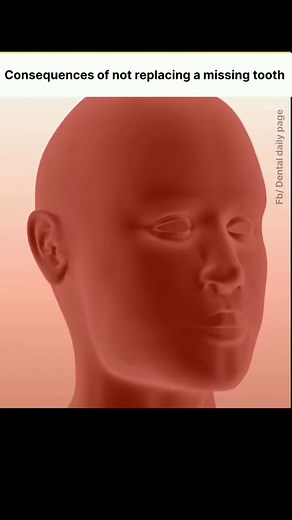 269K views · 957 reactions | Consequences of not replacing missing teeth | Dental animation | Dental Daily | Facebook